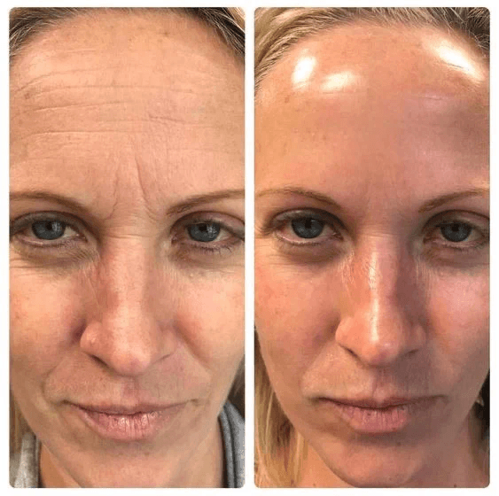 Before and after comparison showing improved skin texture