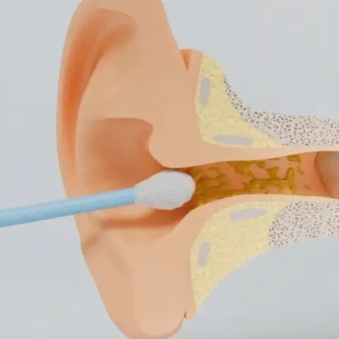 Deep ear cleaning compared to cotton swabs